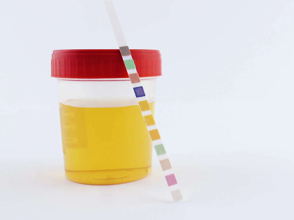 Urine sample with test strip